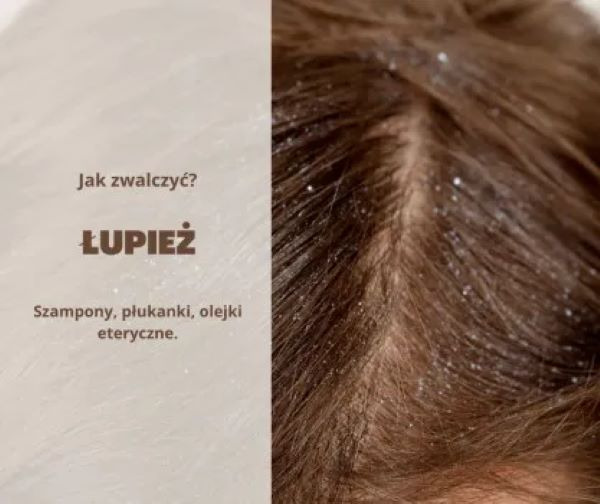 Łupież - jak się go pozbyć bez chemii?